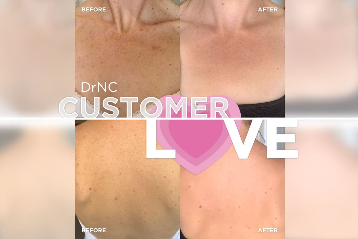 Customer Love - How your products fixed my acne!