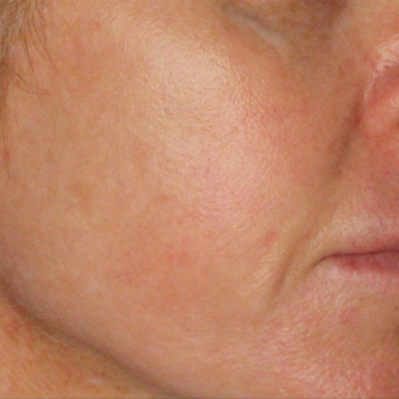 Sun Rash Scarring The 6 Key Skin Concerns – drNC Skin | Dr Natasha Cook